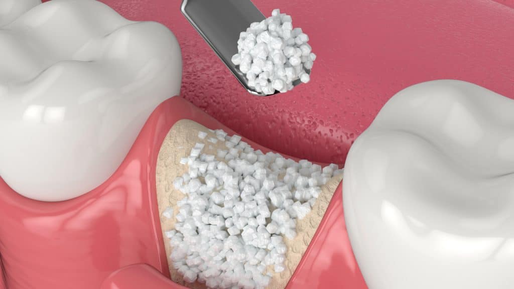 dental bone graft cost in UK