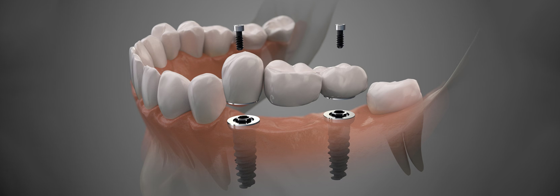 Digital Dentistry: Guided Implant Placement