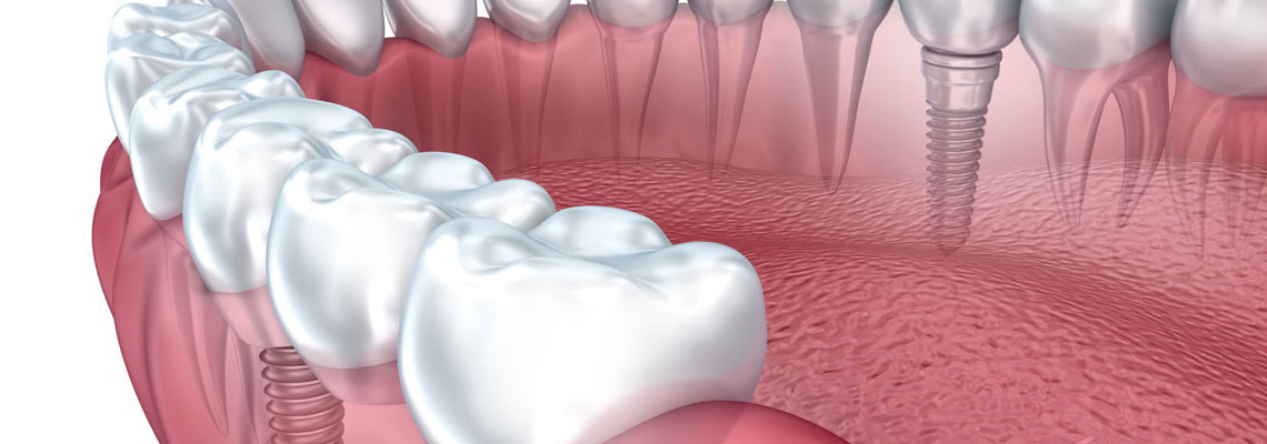 Reclaim Your Smile: Basal Implants with Zirconia Crowns